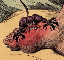 The Gout by James Gillray. Published May 14th 1799.
